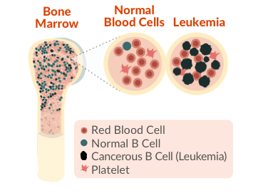 CLL may cause organs to not work picture